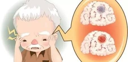 脑血栓要注意什么啊 - 真时天下